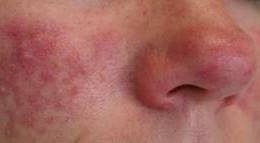 Rosacea Sprundel