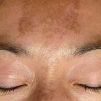 Melasma, ook bekend als zwangerschapsmasker