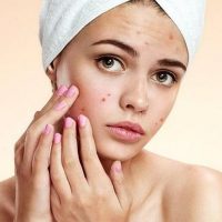 Last van acne? | Tips van de huidtherapeut