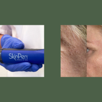 Start nu met échte huidvertering | exclusieve SkinPen actie